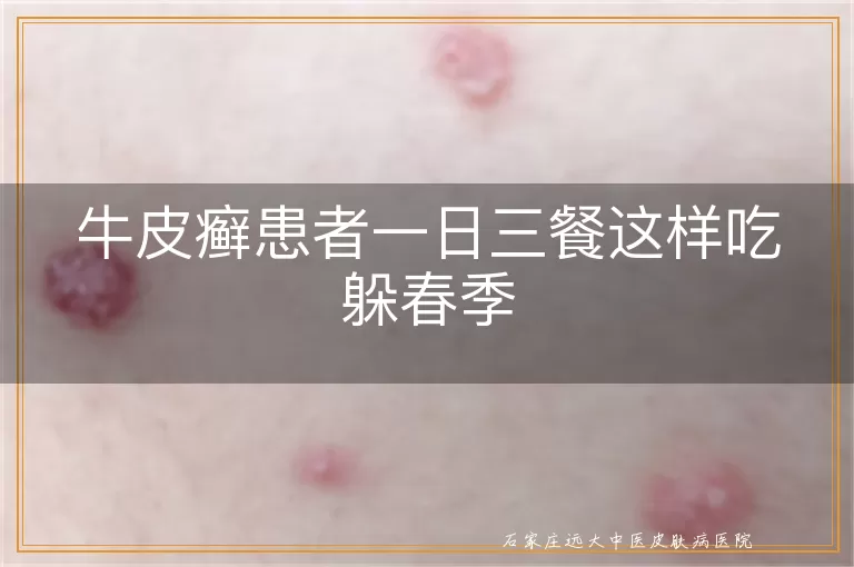 牛皮癣患者一日三餐这样吃躲春季
