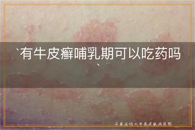 有牛皮癣哺乳期可以吃药吗