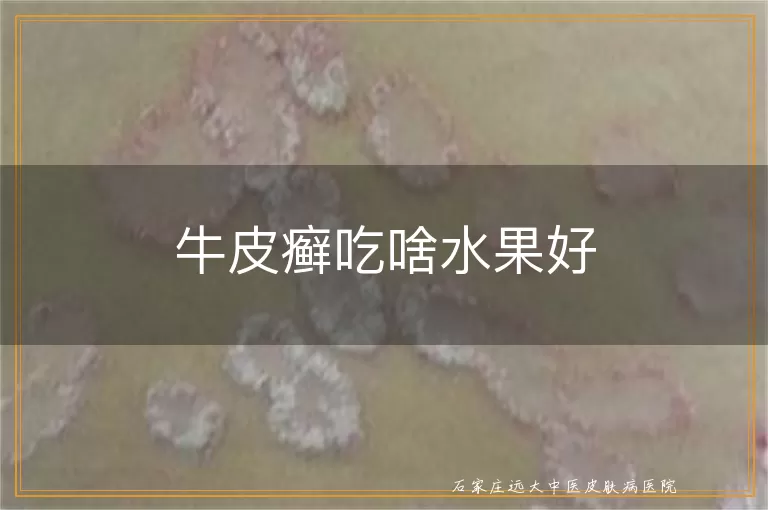 牛皮癣吃啥水果好