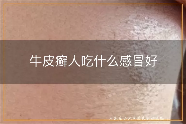 牛皮癣人吃什么感冒好