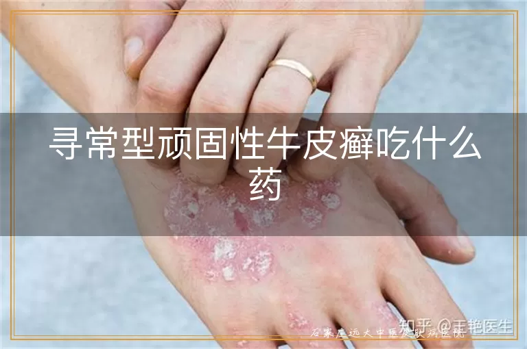 寻常型顽固性牛皮癣吃什么药