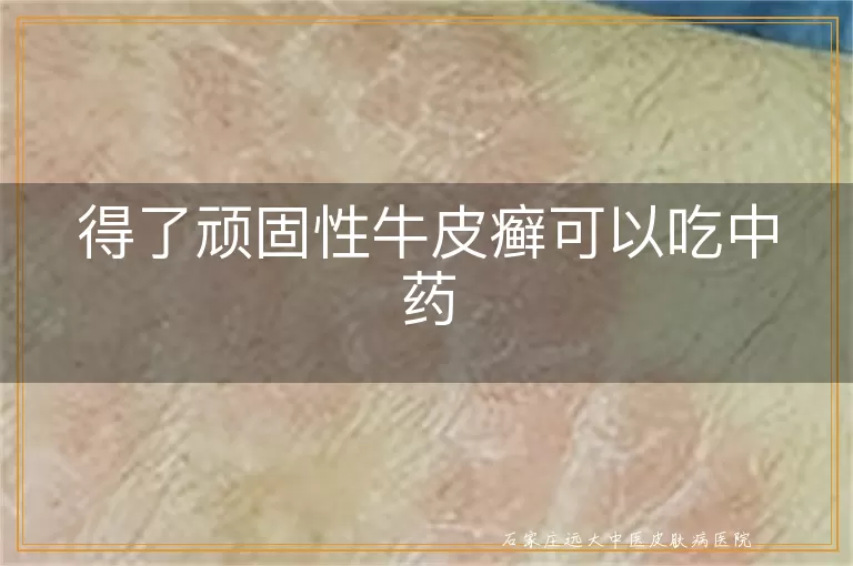得了顽固性牛皮癣可以吃中药