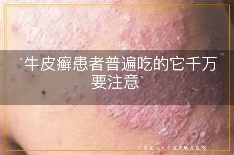牛皮癣患者普遍吃的它千万要注意