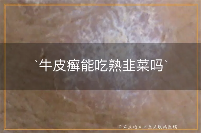 牛皮癣能吃熟韭菜吗