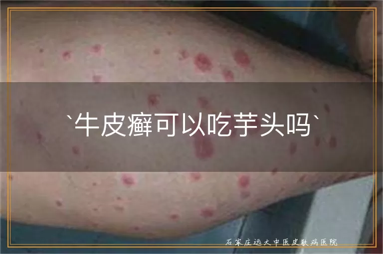 牛皮癣可以吃芋头吗
