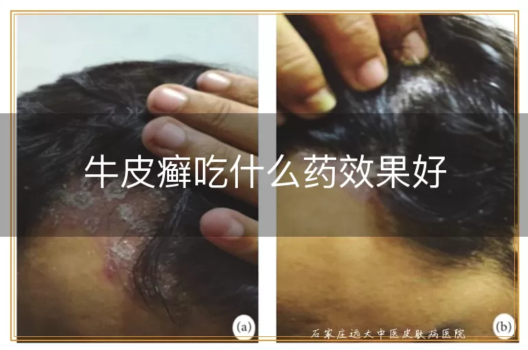牛皮癣吃什么药效果好