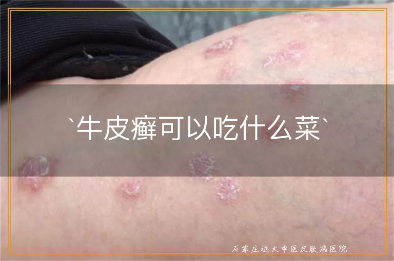 牛皮癣可以吃什么菜