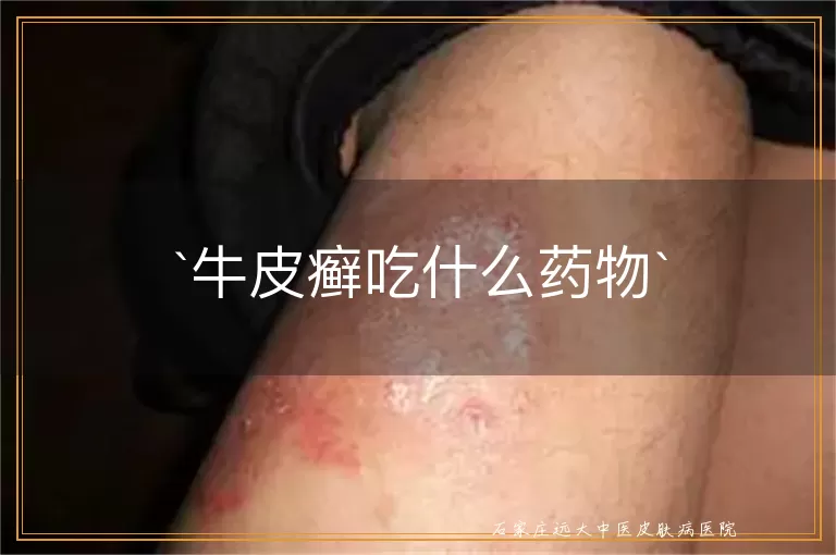 牛皮癣吃什么药物