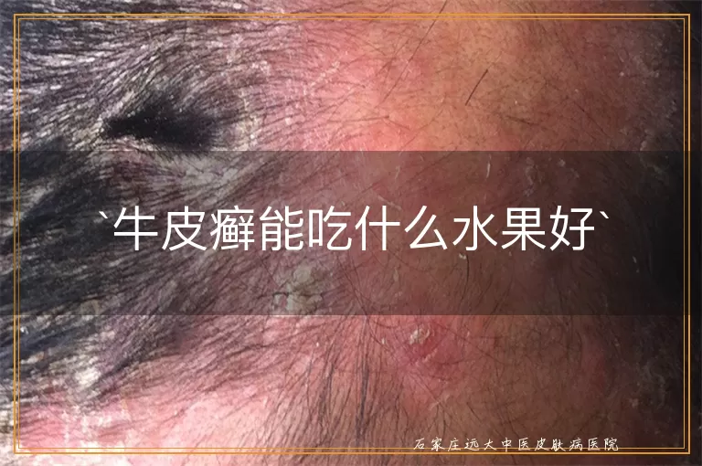 牛皮癣能吃什么水果好
