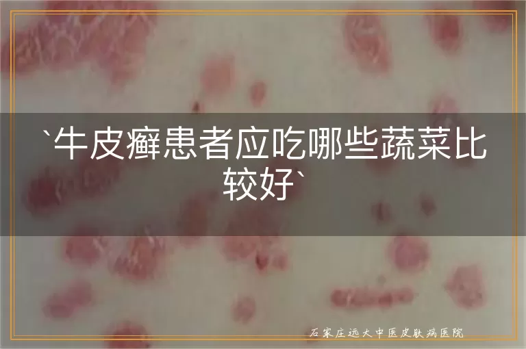 牛皮癣患者应吃哪些蔬菜比较好