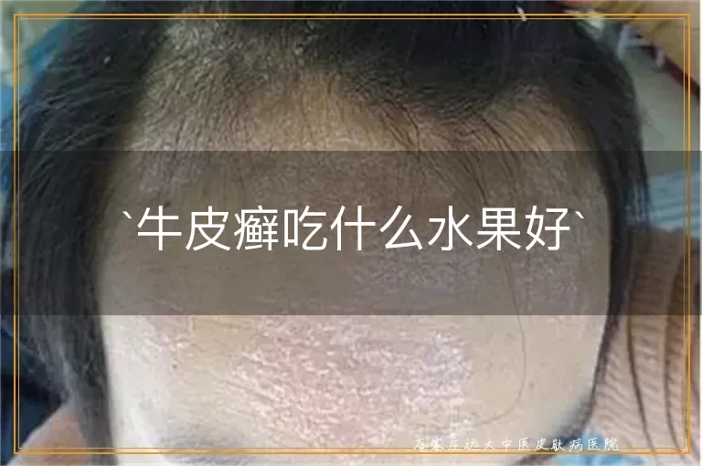 牛皮癣吃什么水果好
