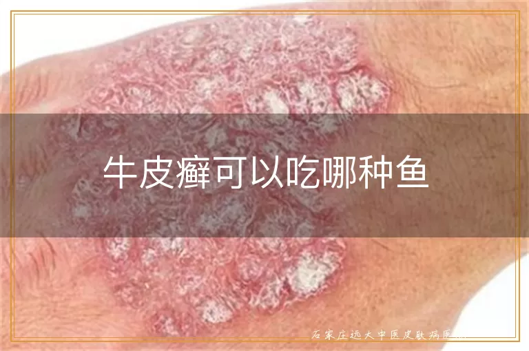 牛皮癣可以吃哪种鱼