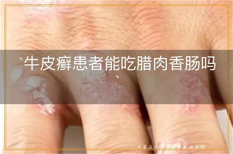 牛皮癣患者能吃腊肉香肠吗