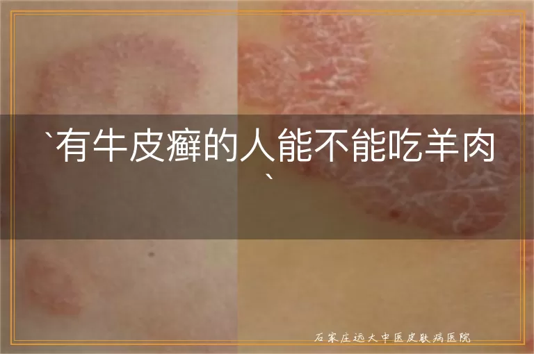 有牛皮癣的人能不能吃羊肉