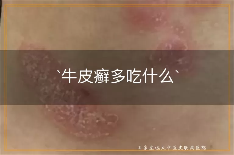 牛皮癣多吃什么