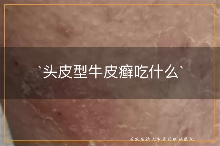 头皮型牛皮癣吃什么