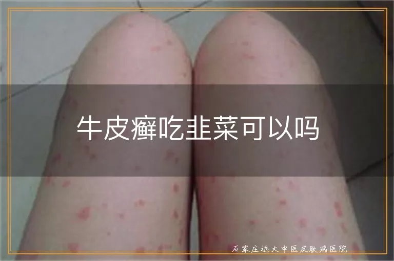 牛皮癣吃韭菜可以吗