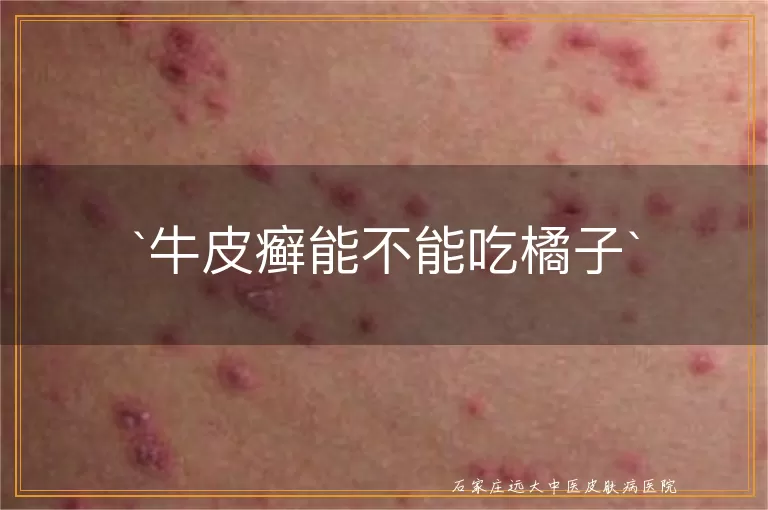 牛皮癣能不能吃橘子