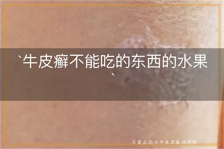 牛皮癣不能吃的东西的水果