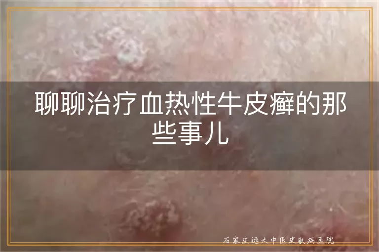 聊聊治疗血热性牛皮癣的那些事儿