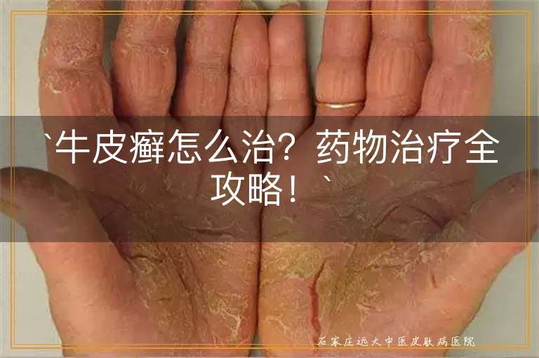 牛皮癣怎么治?药物治疗全攻略!