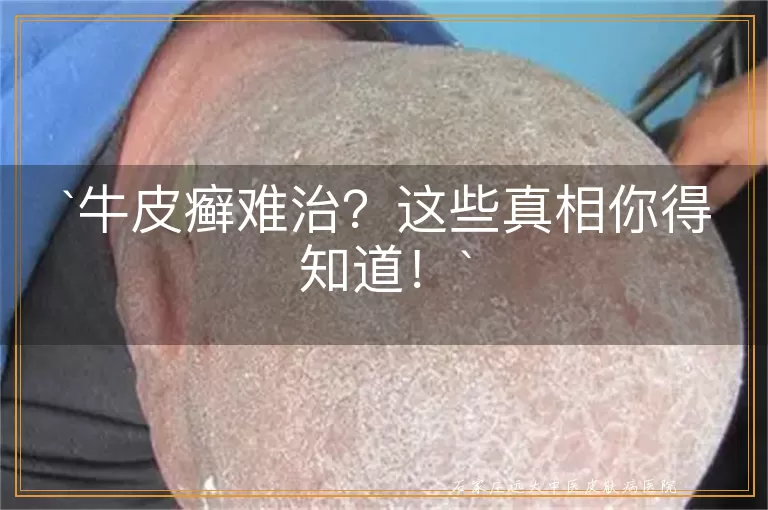 牛皮癣难治?这些真相你得知道!