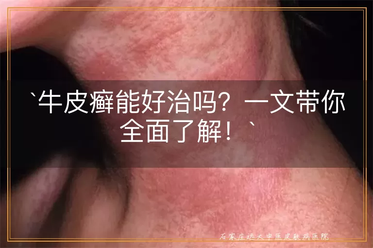 牛皮癣能好治吗?一文带你全面了解!