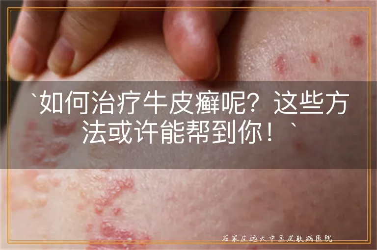 如何治疗牛皮癣呢?这些方法或许能帮到你!