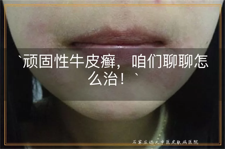 顽固性牛皮癣,咱们聊聊怎么治!