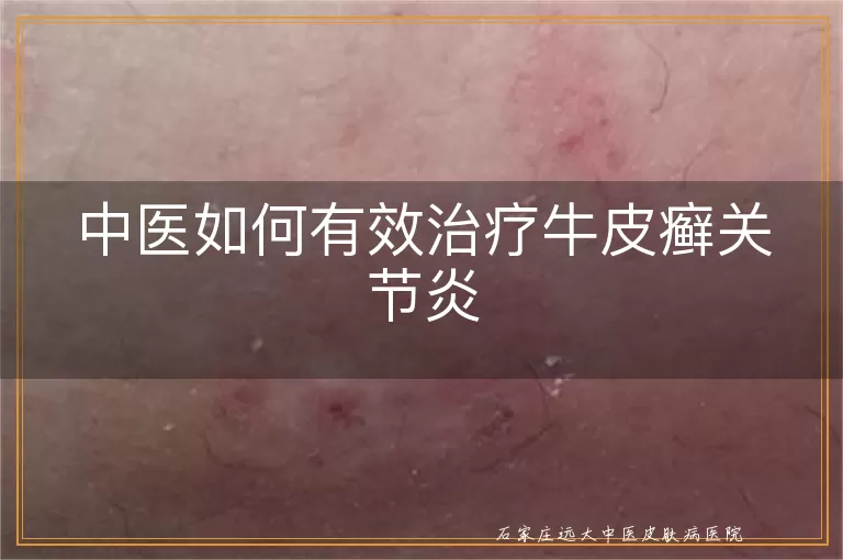 中医如何有效治疗牛皮癣关节炎
