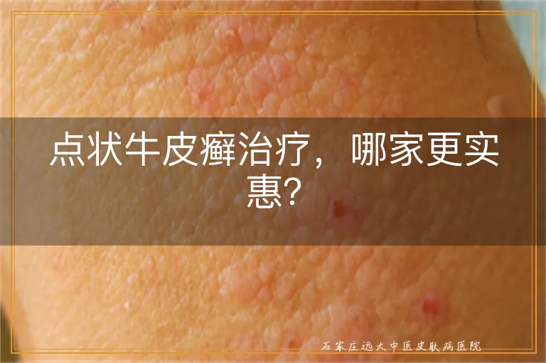 点状牛皮癣治疗,哪家更实惠?
