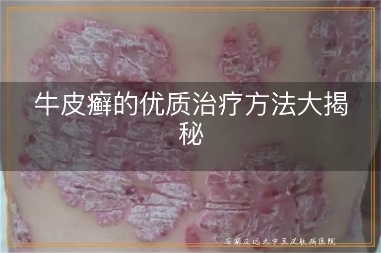 牛皮癣的优质治疗方法大揭秘