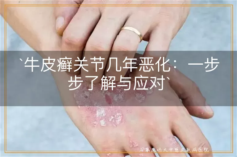 牛皮癣关节几年恶化:一步步了解与应对
