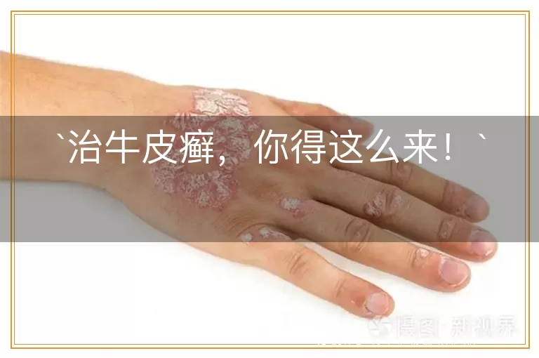 治牛皮癣,你得这么来!