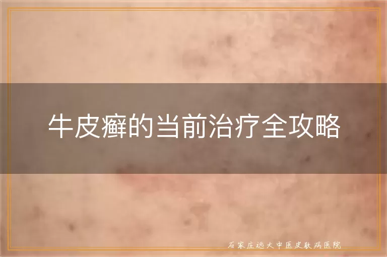 牛皮癣的当前治疗全攻略