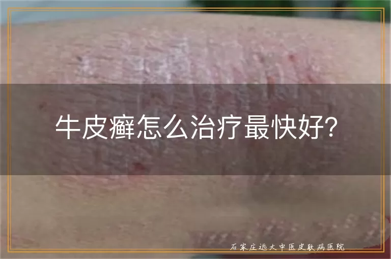 牛皮癣怎么治疗最快好？
