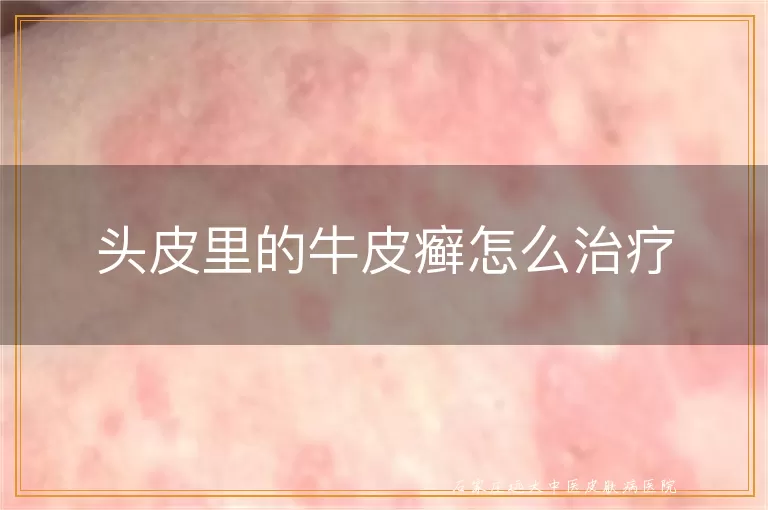 头皮里的牛皮癣怎么治疗