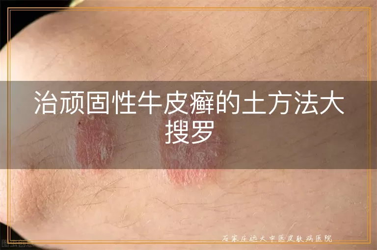 治顽固性牛皮癣的土方法大搜罗