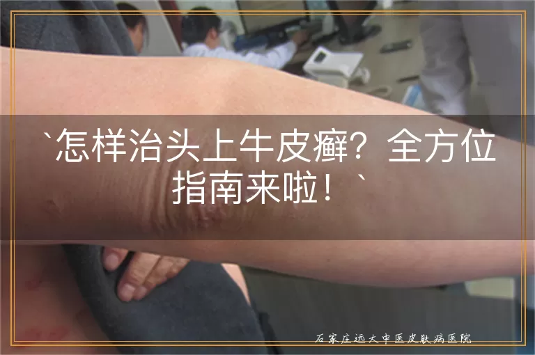怎样治头上牛皮癣?全方位指南来啦!