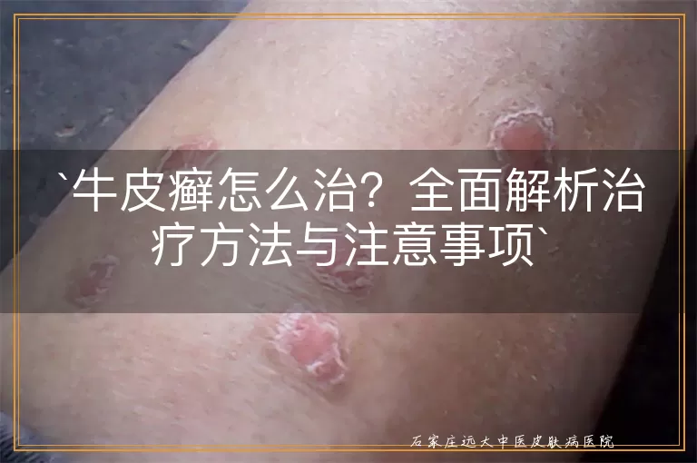 牛皮癣怎么治?全面解析治疗方法与注意事项