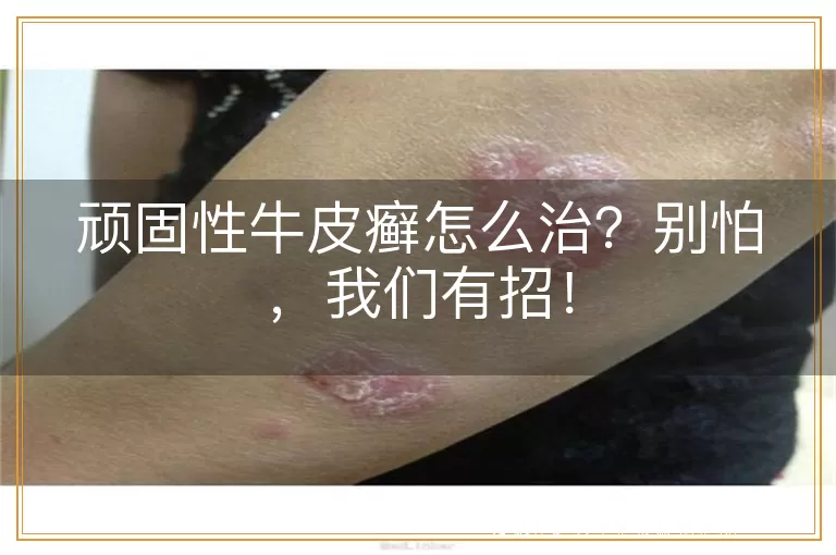顽固性牛皮癣怎么治？别怕，我们有招！