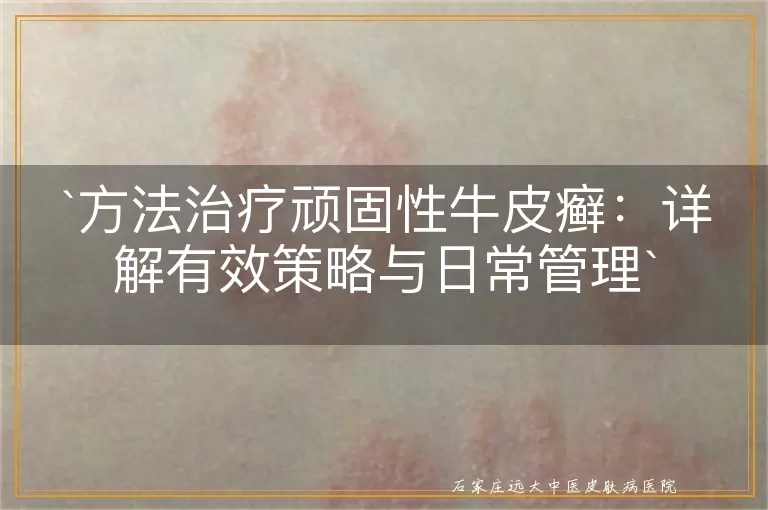 方法治疗顽固性牛皮癣:详解有效策略与日常管理