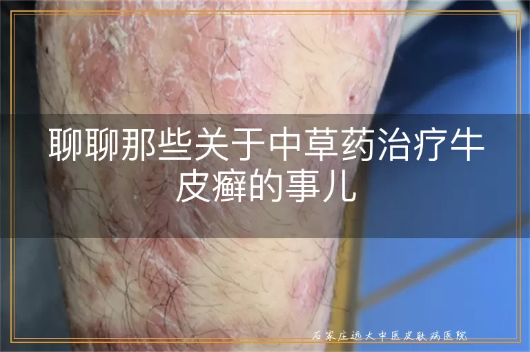 聊聊那些关于中草药治疗牛皮癣的事儿
