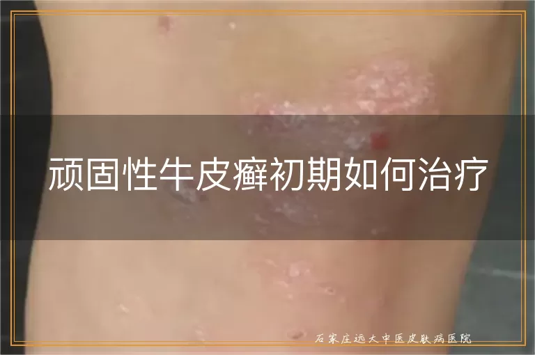 顽固性牛皮癣初期如何治疗