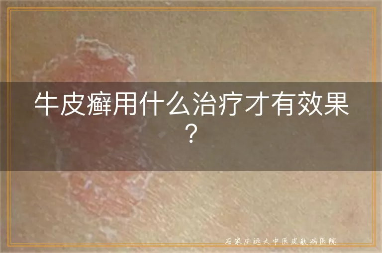 牛皮癣用什么治疗才有效果？
