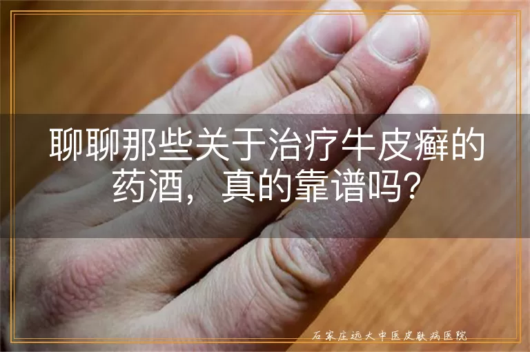 聊聊那些关于治疗牛皮癣的药酒，真的靠谱吗？