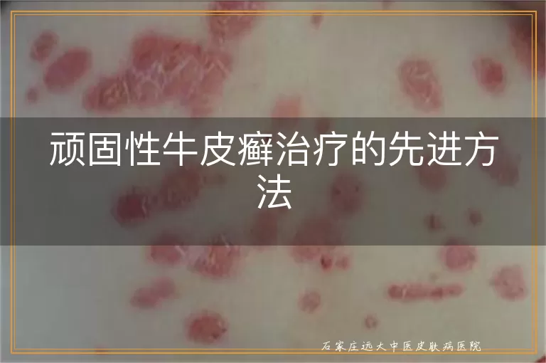顽固性牛皮癣治疗的先进方法
