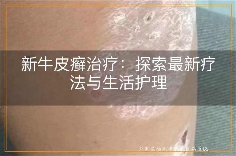 新牛皮癣治疗:探索最新疗法与生活护理