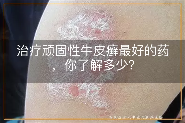 治疗顽固性牛皮癣最好的药，你了解多少？