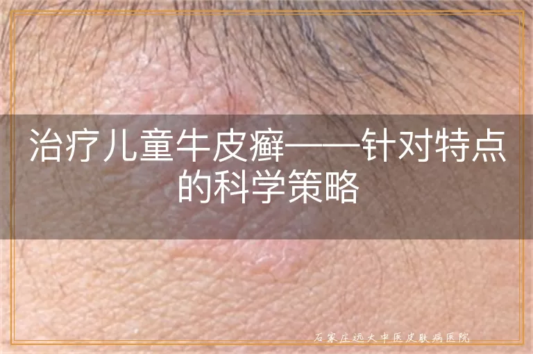 治疗儿童牛皮癣——针对特点的科学策略